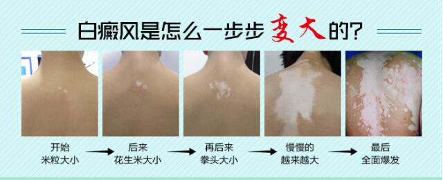 白癜风的初期症状及图片